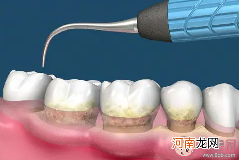 洗牙危害|洗牙会有危害吗 一年洗几次牙合适