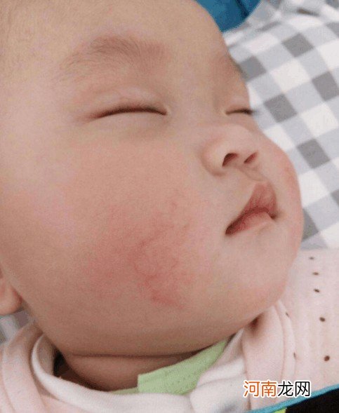 怎么预防宝宝脸皴呢 宝宝脸皴怎么办
