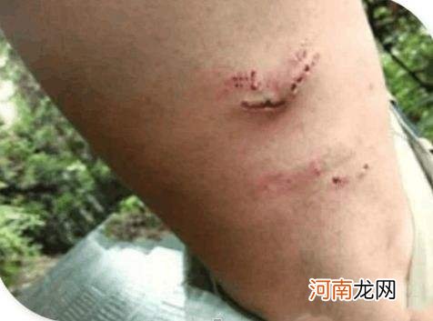 梦到蛇咬自己腿是什么征兆女性 女人梦到蛇咬自己腿预示着什么