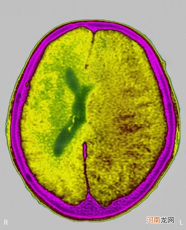 脑水肿多久才消退 新生儿脑水肿会自