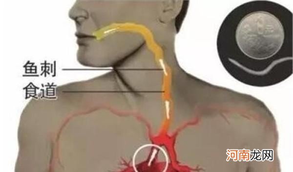 落枕了一招搞定10秒 落枕了什么办法最有效