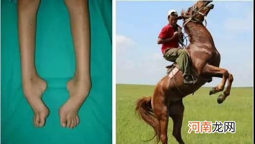 什么是马蹄足 先天性马蹄内翻足治疗方法