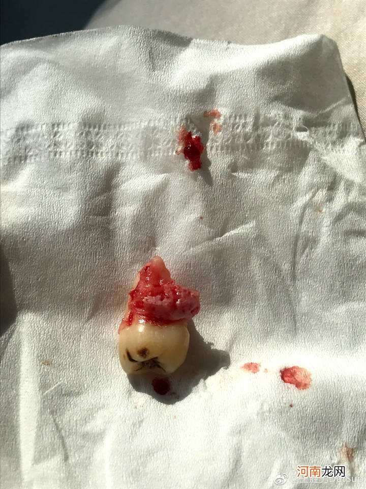 智齿运势 智齿的状况