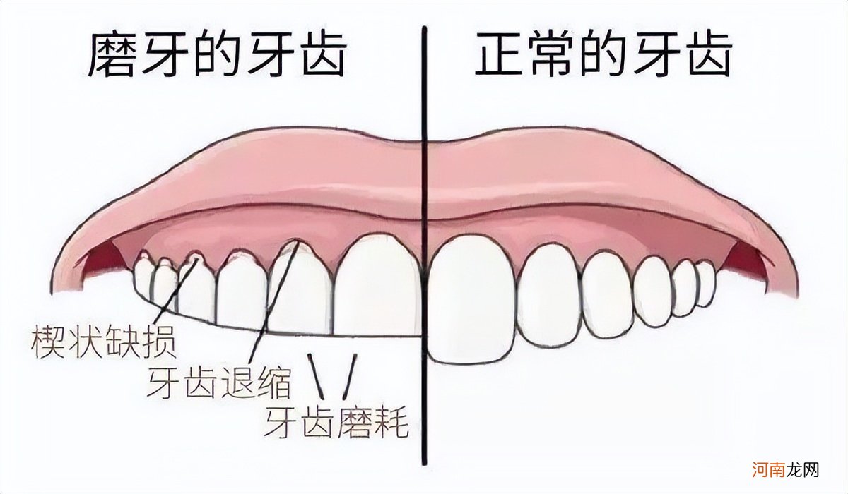 孩子磨牙别大意，3种磨牙类型要识别，别让“后遗症”毁脸又毁牙