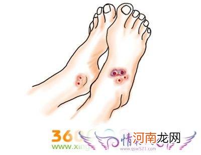 女人梦到被蛇咬到手掌是什么 女人梦到被蛇咬手预示着什么