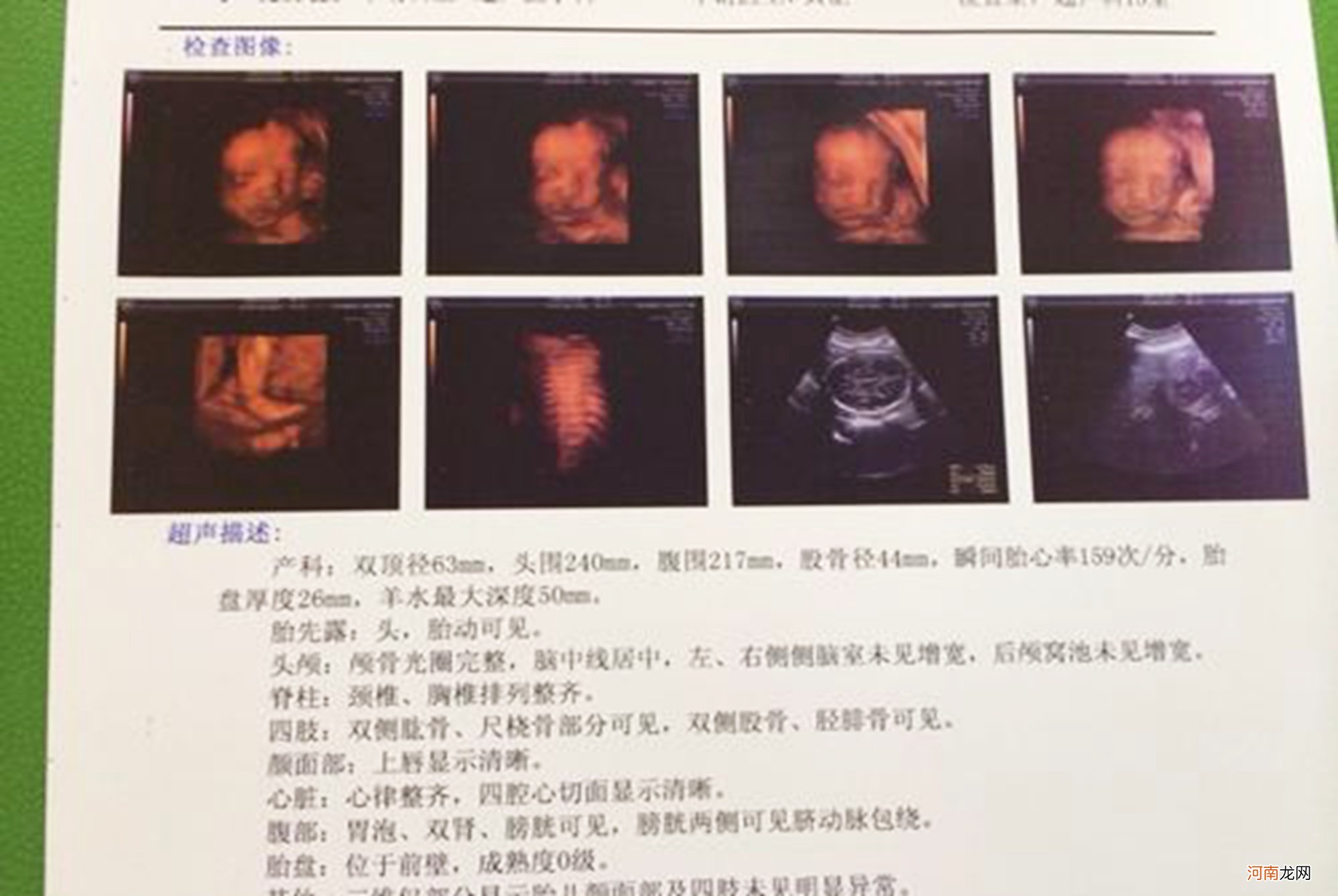 孕早期B超单上的四个指标，暗含了胎儿的“小秘密”，你看得懂吗