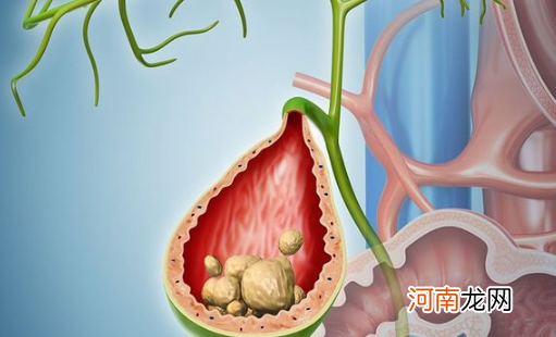 体检肾结晶但是没有症状怎么回事