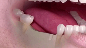 做了一颗种植牙还可以，对安检是否有影响？