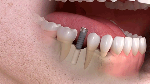 做了一颗种植牙还可以，对安检是否有影响？
