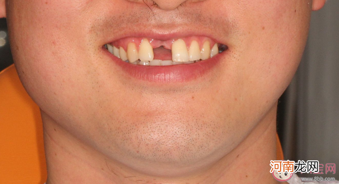 缺牙|缺牙让预期寿命缩短11.7年 牙齿缺失有什么危害