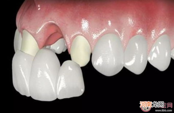 缺牙|缺牙让预期寿命缩短11.7年 牙齿缺失有什么危害