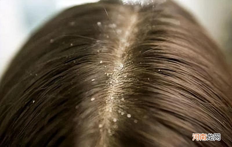 为什么用硫磺皂洗头会掉头发 硫磺皂洗头会掉头发吗