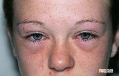 眼皮肿的6个可能因素 眼皮肿是什么原因造成的