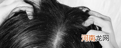 头屑多简单去除方法