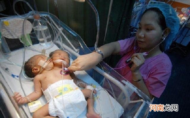 双头女婴畸形的原因 双头宝宝现在怎么样了