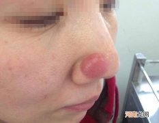 皮肤假性淋巴瘤介绍及治疗 鼻子上长红包是什么