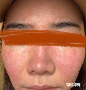 皮肤瘙痒的原因及缓解方法 脸上过敏痒怎么办