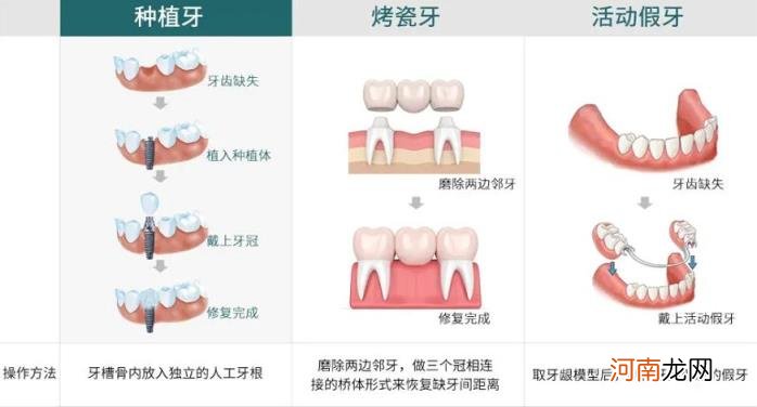 牙齿掉了安装一颗假牙多少钱 牙齿掉了安一颗多少钱