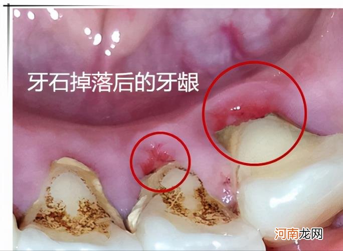 洗牙一次大概多少钱 清洗一次多长时间？