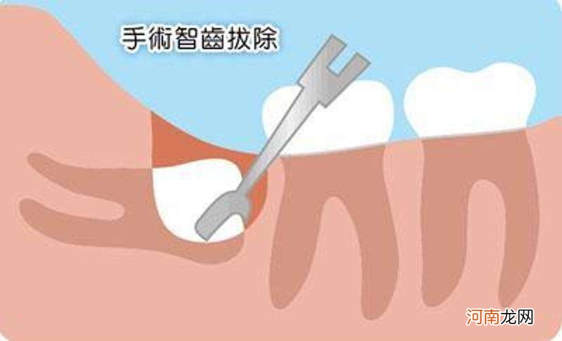 智齿疼怎么办缓解疼痛 智齿疼怎么办缓解疼痛图片