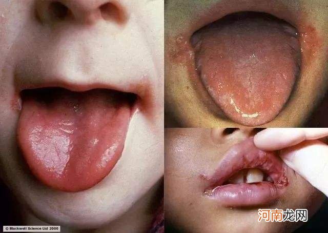 嘴角裂口是什么原因怎么办 嘴角裂口是什么原因怎么办传染吗