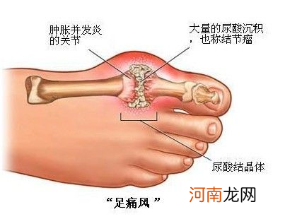 脚痛风怎么办 脚痛风怎么办快速止痛土方法