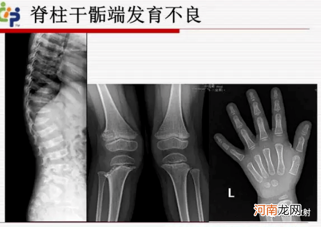 发育不良怎么办 新生儿髋关节发育不良怎么办