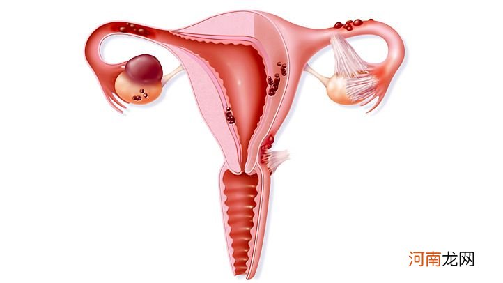 输卵管堵塞怎么办 炎症引起输卵管堵塞怎么办