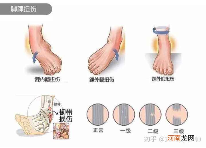 脚踝扭伤怎么办 踢球时脚踝扭伤怎么办