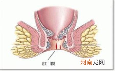 肛裂怎么办 屎太大导致肛裂怎么办