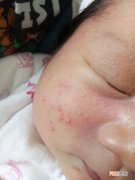宝宝脸上长湿疹怎么办 两个多月的宝宝脸上长湿疹怎么办