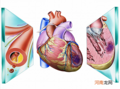 心肌缺血怎么办 心肌缺血是什么原因造成的