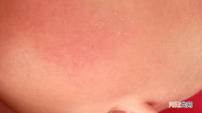 宝宝脸上湿疹怎么办 50天宝宝脸上湿疹怎么办