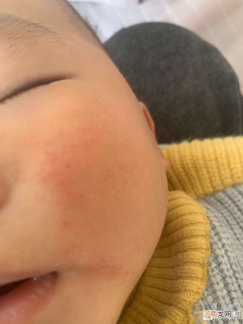 宝宝有湿疹怎么办 6个月的宝宝有湿疹怎么办