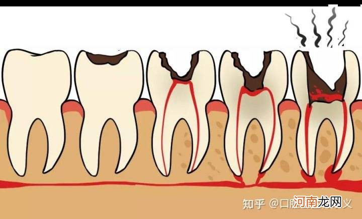 长智齿牙疼怎么办 长智齿牙疼怎么办 教你6招缓解牙痛