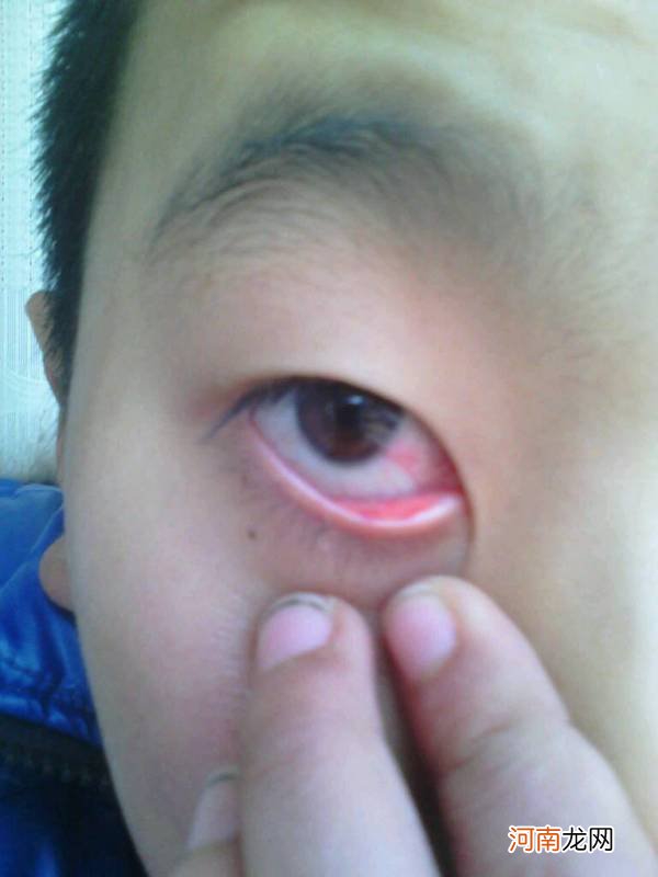 眼睛红血丝怎么办 眼睛红血丝怎么办快速消除