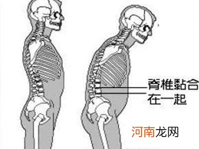 强直性脊柱炎怎么办 强直性脊柱炎怎么办理特殊门诊