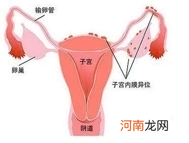 子宫壁薄怎么办 孕中期子宫壁薄怎么办