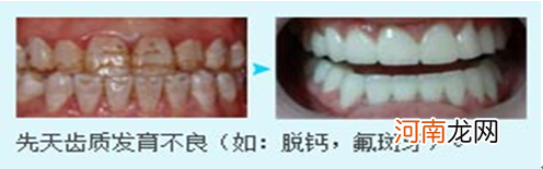 换一颗牙齿要多少钱 换一颗牙齿大概多少钱左右