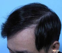 油脂性脱发怎么办 如何缓解油脂性脱发
