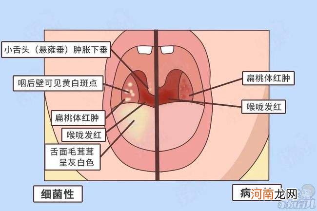 宝宝嗓子哑了怎么办 2岁宝宝嗓子哑了怎么办