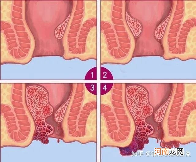 痔疮掉出来了怎么办 拉屎痔疮掉出来了怎么办