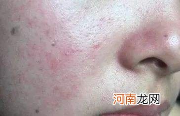 脸过敏怎么办 孩子化妆后脸过敏怎么办