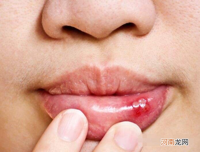 口腔溃疡严重怎么办 手术后口腔溃疡严重怎么办