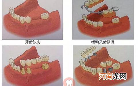 满口假牙需要多少钱的简单介绍