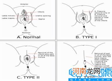 女性割礼后痊愈图片 割礼是什么样子的