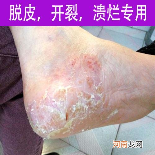脚后跟干裂起硬皮怎么办 真菌感染脚后跟干裂起硬皮怎么办