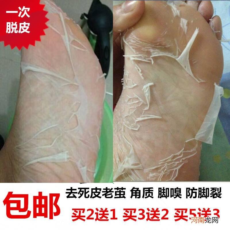 脚后跟干裂起硬皮怎么办 真菌感染脚后跟干裂起硬皮怎么办