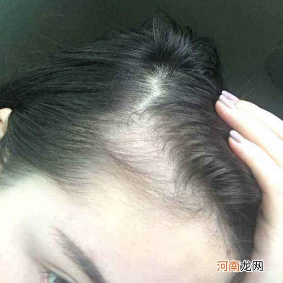 女性脱发怎么办 女性脱发怎么办吃点什么