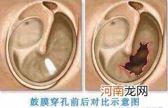 耳膜穿孔怎么办 耳膜穿孔怎么办?